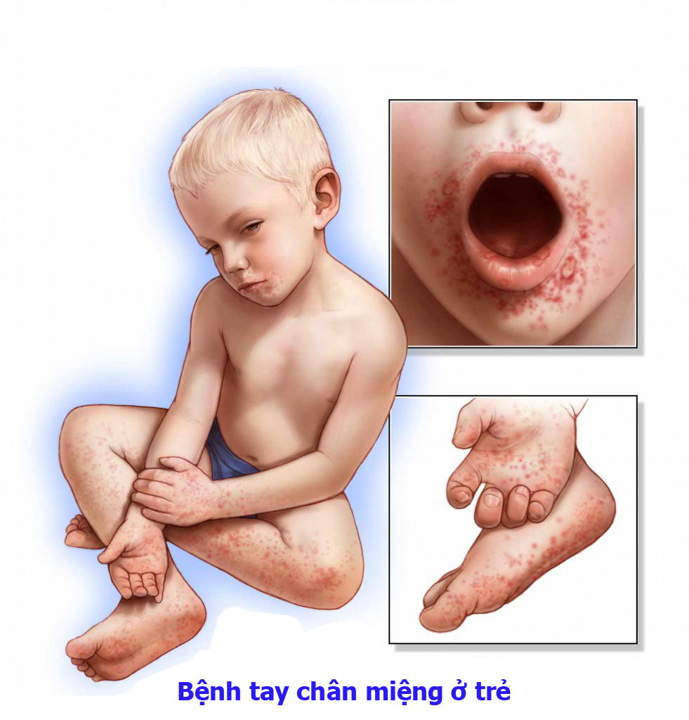 Biện pháp phòng chống bệnh tay chân miệng ở trẻ 