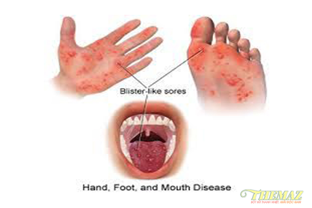 Phương pháp điều trị và cách phân biệt bệnh tay chân miệng ở trẻ với một số bệnh khác 