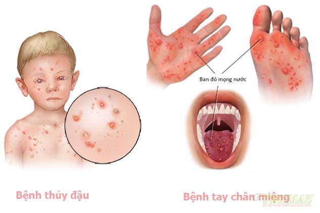 Cách phòng chống và phân biệt bệnh tay chân miệng và bệnh thủy đậu ở trẻ 